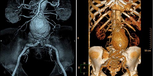 Aneurysmen der Brust- und Bauchschlagader (Aortenaneurysma): CT Bauchaortenaneurysma