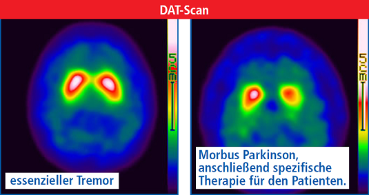 Nuklearmedizin, DAT-Scan: Parkinson oder Alzheimer?